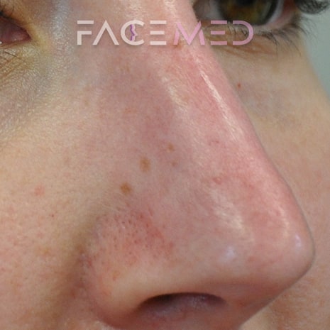 non_surgical_rhinoplasty_post_09