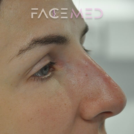 non_surgical_rhinoplasty_post_10
