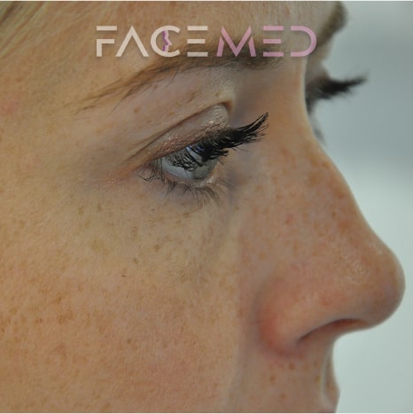 non_surgical_rhinoplasty_pre_01