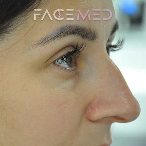 non_surgical_rhinoplasty_pre_02