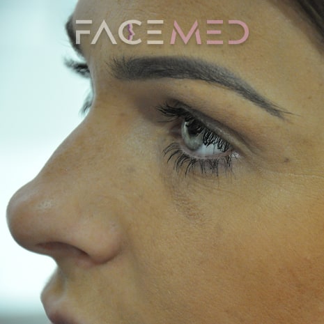 non_surgical_rhinoplasty_pre_03