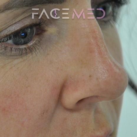 non_surgical_rhinoplasty_pre_04