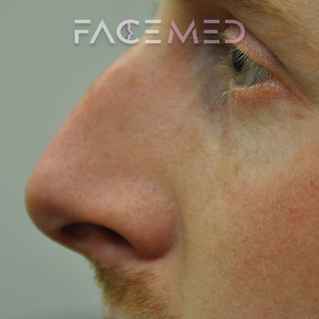 non_surgical_rhinoplasty_pre_05