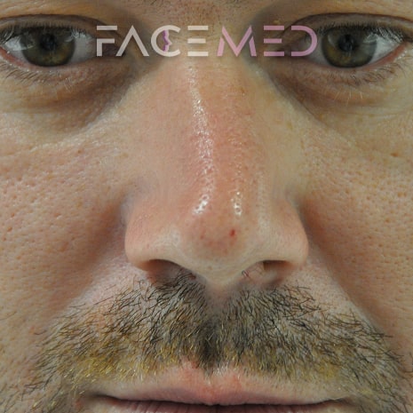 non_surgical_rhinoplasty_pre_06