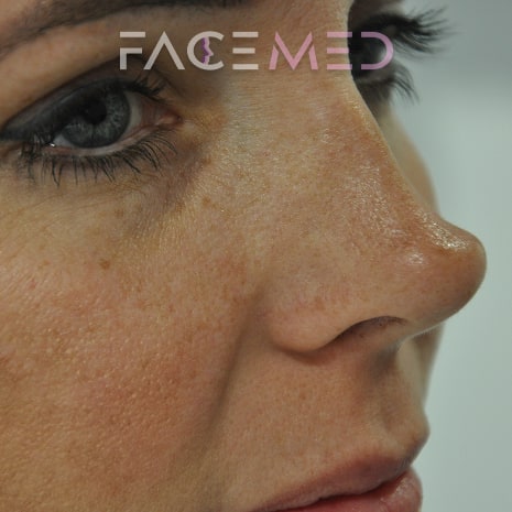 non_surgical_rhinoplasty_pre_08