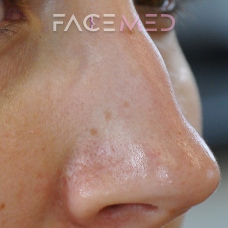 non_surgical_rhinoplasty_pre_09
