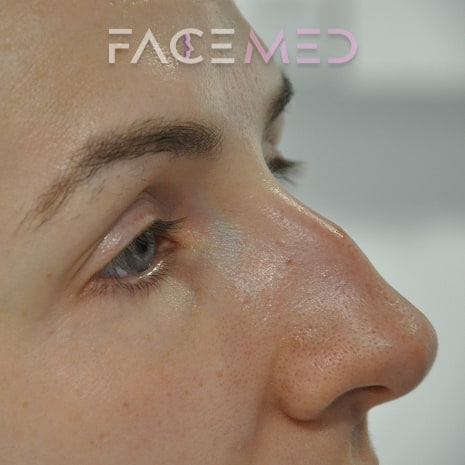 non_surgical_rhinoplasty_pre_10