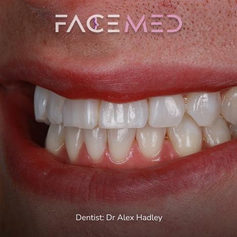 Whitening_post_02