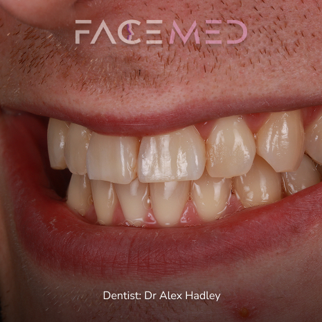 Whitening_pre_02