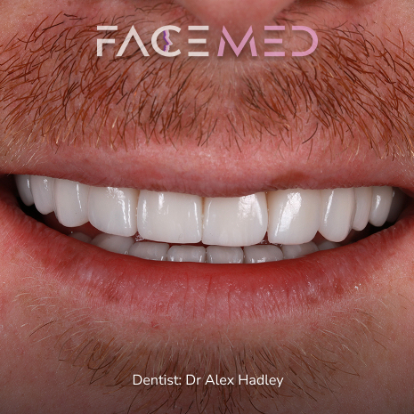 porcelain_veneers_post02