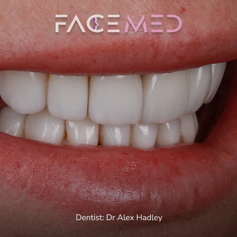 porcelain_veneers_post03