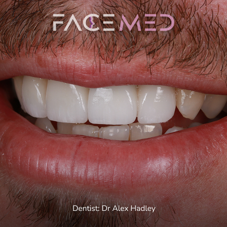 porcelain_veneers_post05