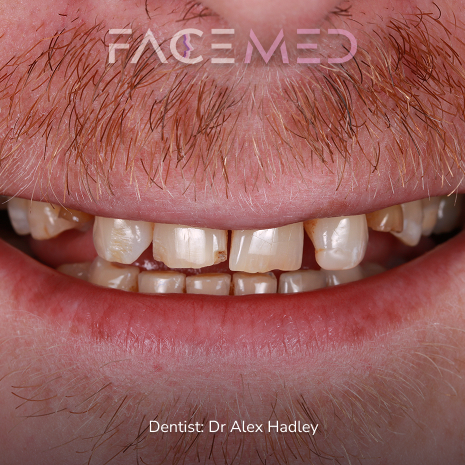 porcelain_veneers_pre_02