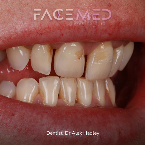 porcelain_veneers_pre_03
