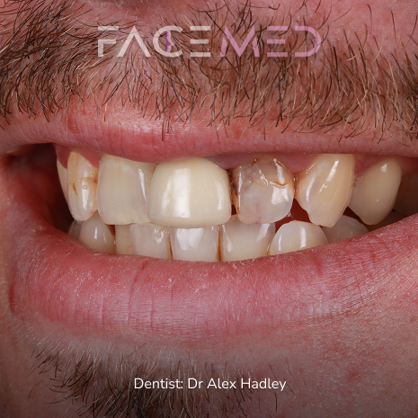 porcelain_veneers_pre_05