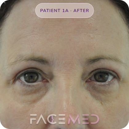 Upper_bletheroplasty_post_01