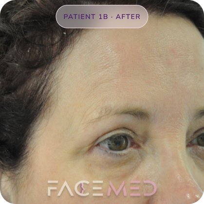 Upper_bletheroplasty_post_02