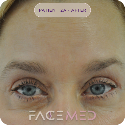 Upper_bletheroplasty_post_03