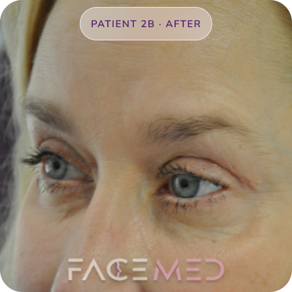 Upper_bletheroplasty_post_04