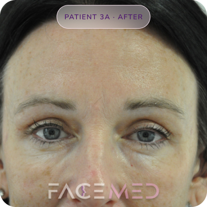 Upper_bletheroplasty_post_05