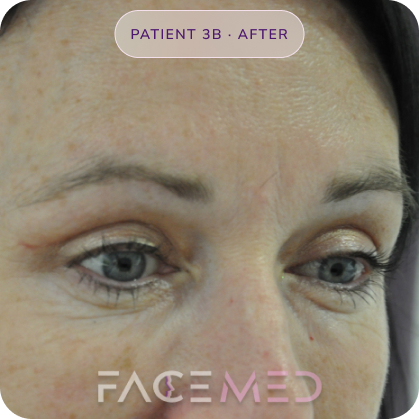 Upper_bletheroplasty_post_06