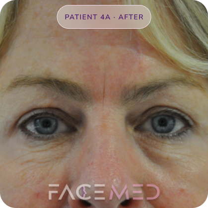 Upper_bletheroplasty_post_07