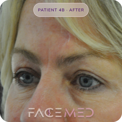 Upper_bletheroplasty_post_08