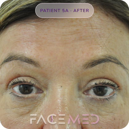 Upper_bletheroplasty_post_09