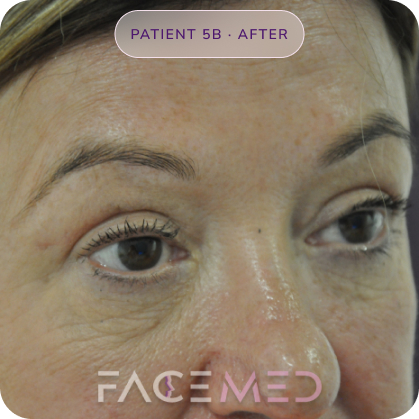 Upper_bletheroplasty_post_10