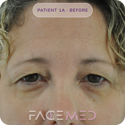 Upper_bletheroplasty_pre_01