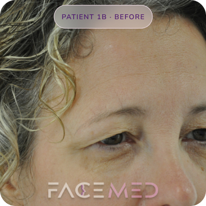 Upper_bletheroplasty_pre_02