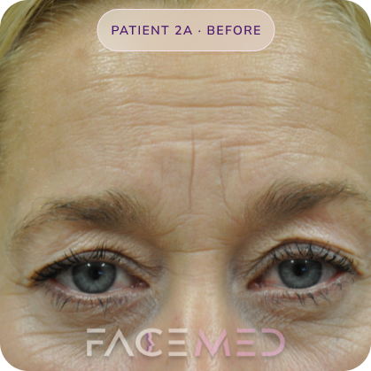 Upper_bletheroplasty_pre_03