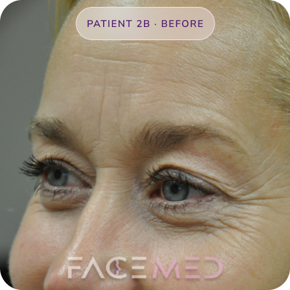 Upper_bletheroplasty_pre_04