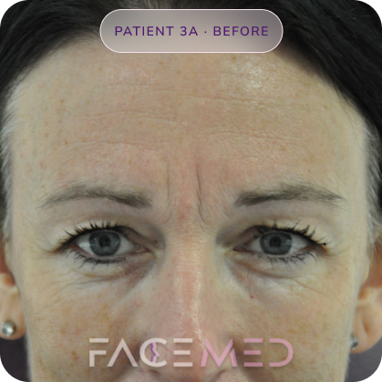 Upper_bletheroplasty_pre_05