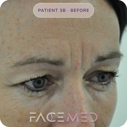 Upper_bletheroplasty_pre_06