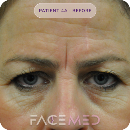 Upper_bletheroplasty_pre_07