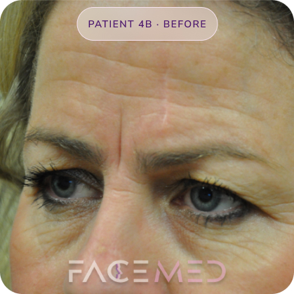 Upper_bletheroplasty_pre_08