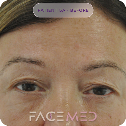 Upper_bletheroplasty_pre_09