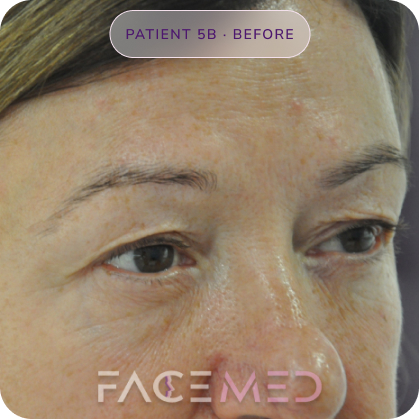 Upper_bletheroplasty_pre_10