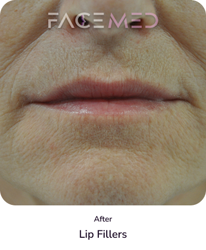 lips_1_after