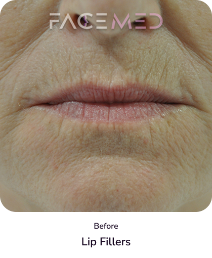 lips_1_before