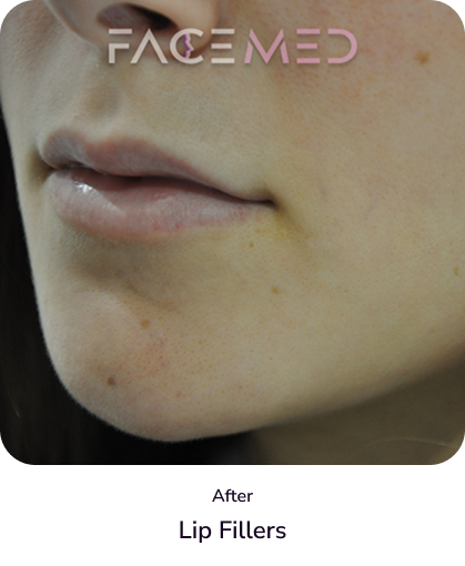 lips_2_after