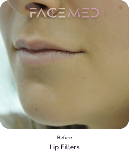 lips_2_before