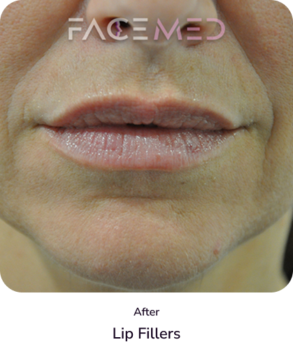lips_3_after