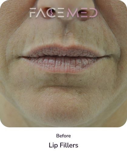 lips_3_before