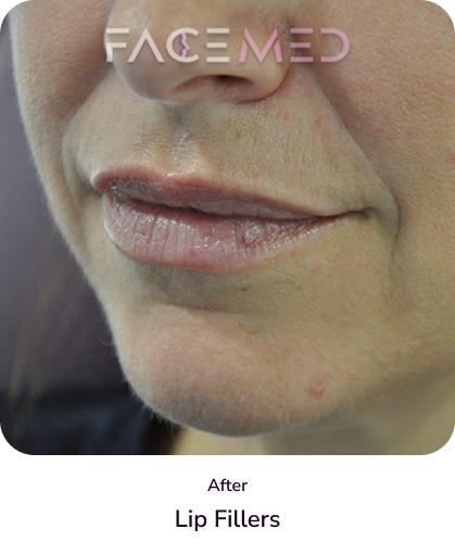 lips_4_after