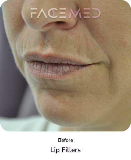 lips_4_before