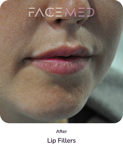 lips_5_after