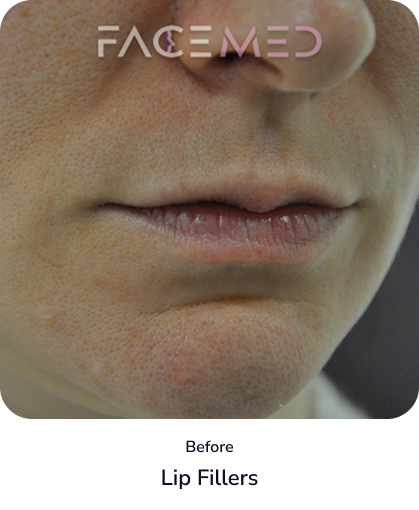 lips_5_before
