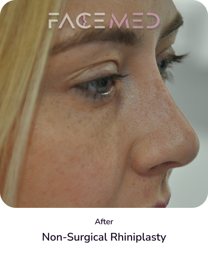 rhinoplasty_1_after